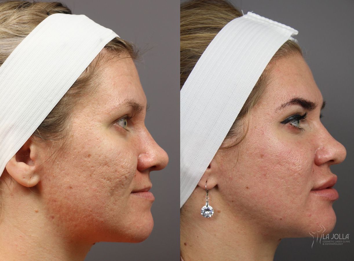 Before and after Lip Filler case 36313 - Angle 2