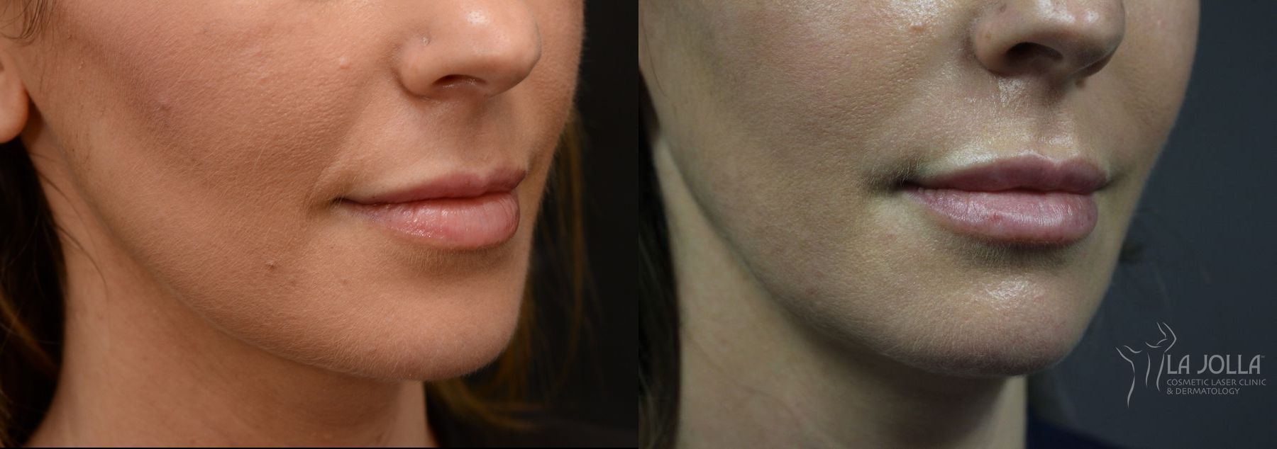 Before and after Lip Filler case 36290