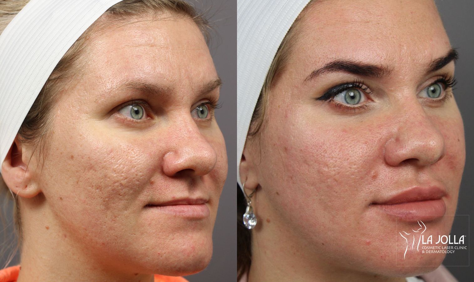 Before and after Lip Filler case 36313