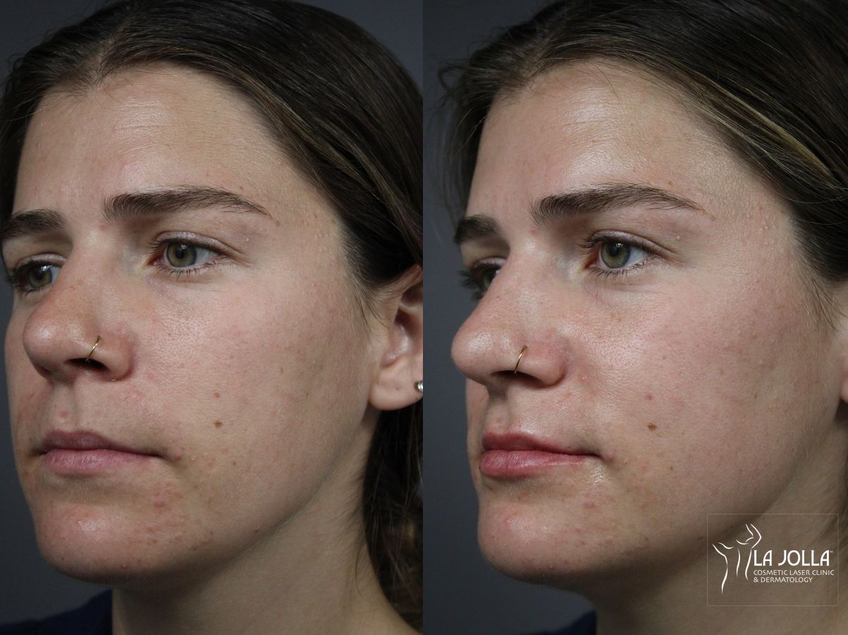 Before and after Lip Filler case 36141 - Angle 3