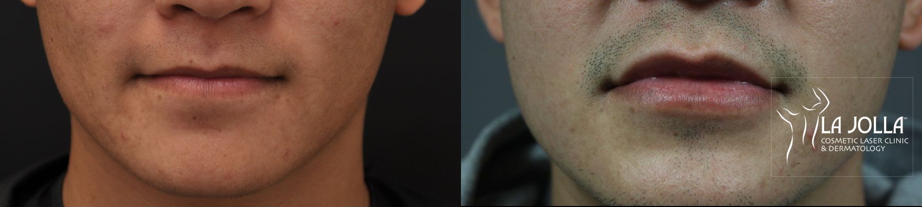 Before and after Lip Filler case 36293