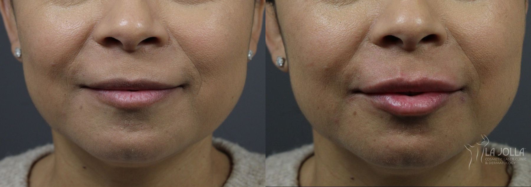 Before and after Lip Filler case 36080