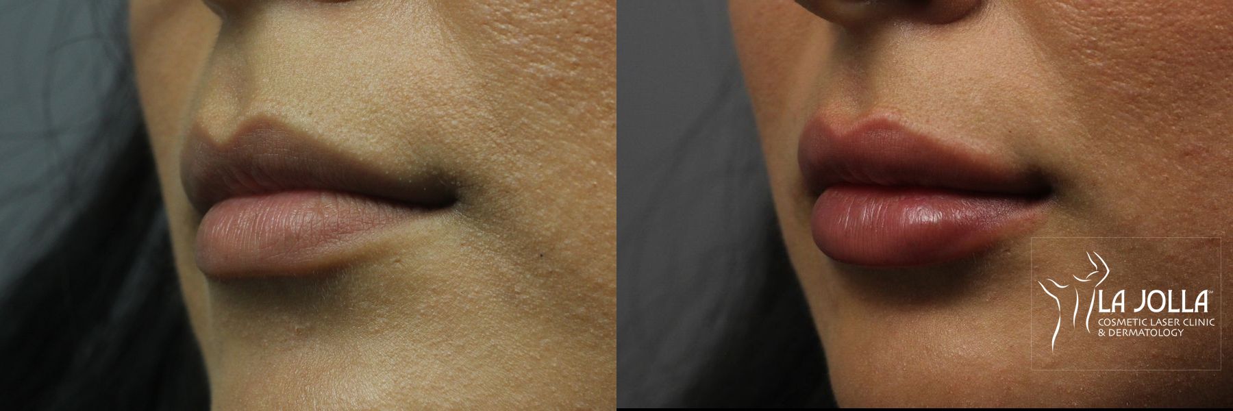 Before and after Lip Filler case 36139