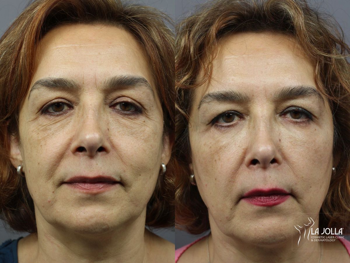 Before and after Lip Filler case 36314