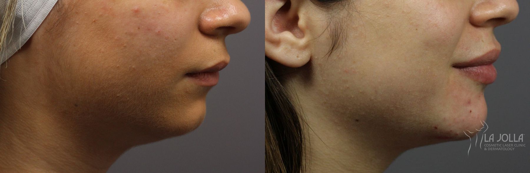 Before and after Lip Filler case 36326