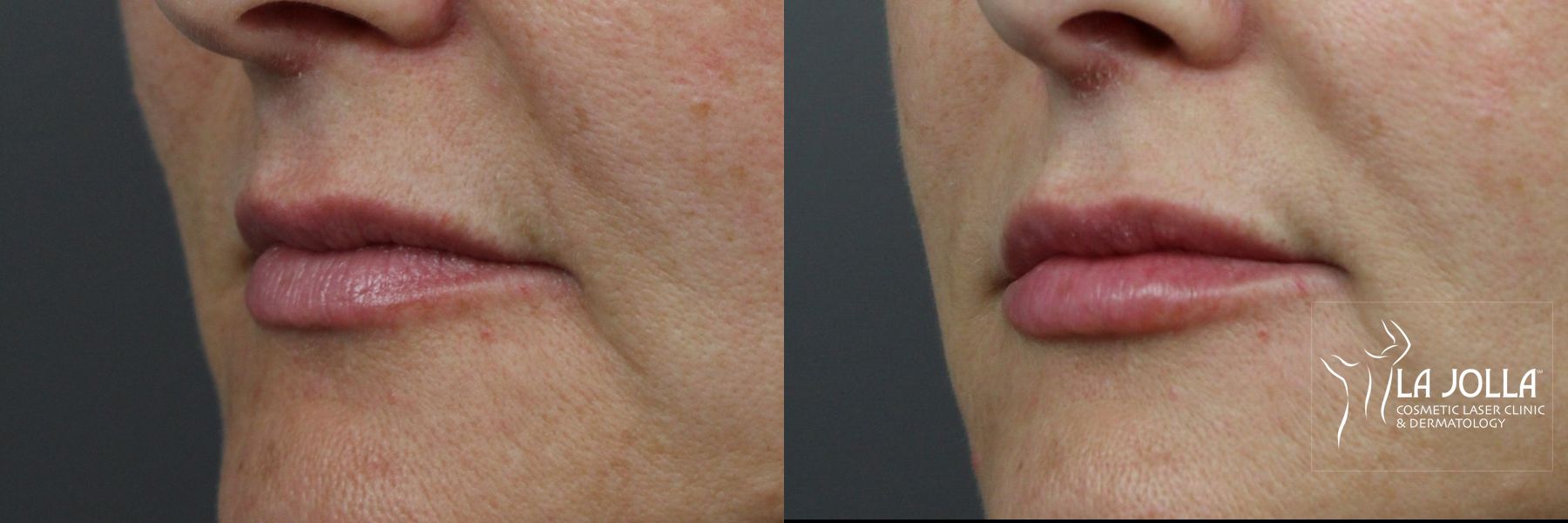 Before and after Lip Filler case 36186