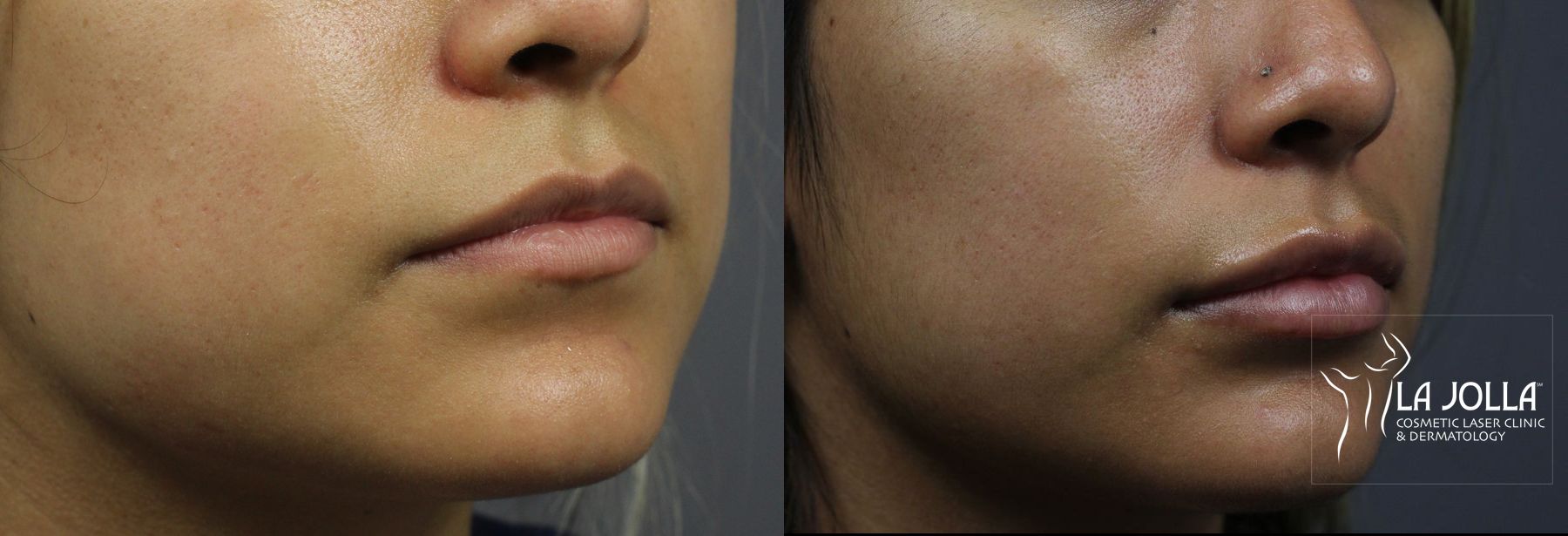 Before and after Lip Filler case 36321 - Angle 2
