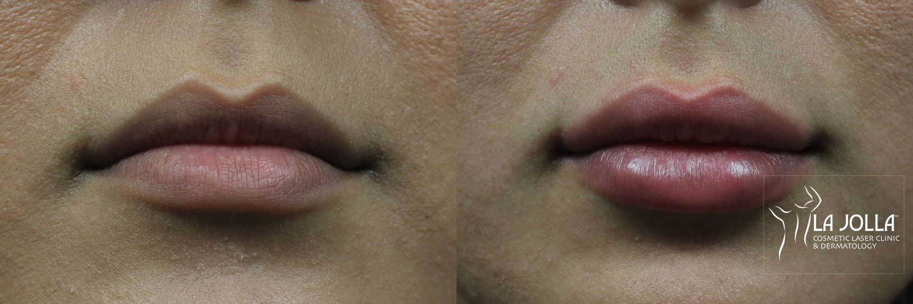 Before and after Lip Filler case 36139 - Angle 2