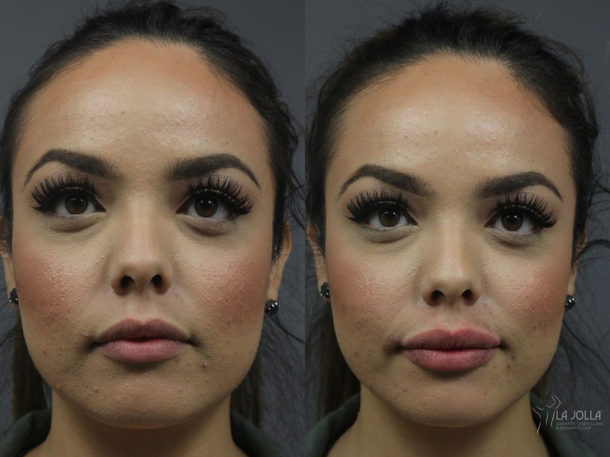 Before and after Lip Filler case 36205