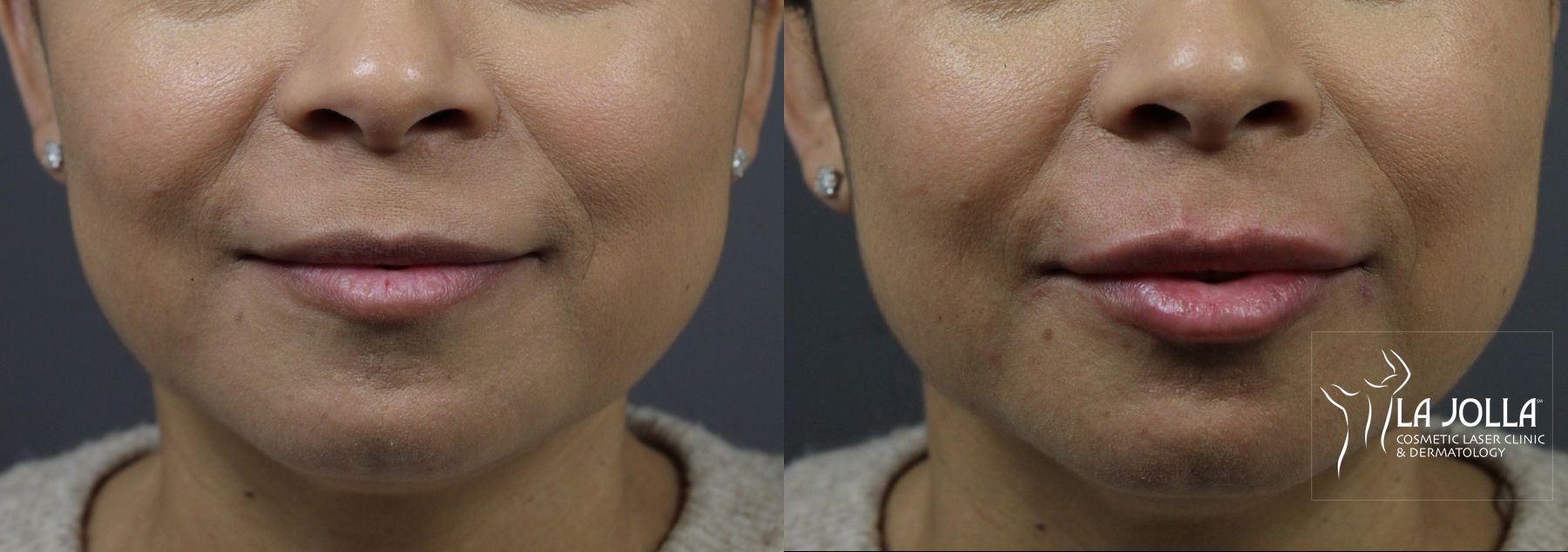Before and after Lip Filler case 36080