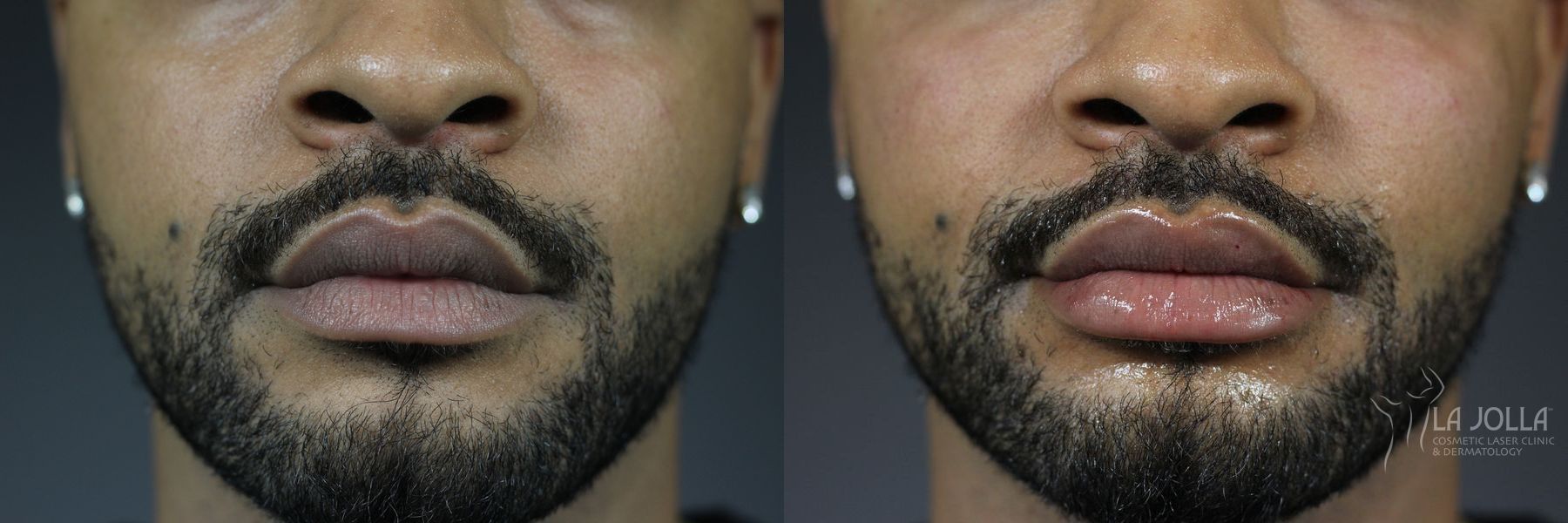 Before and after Lip Filler case 36336