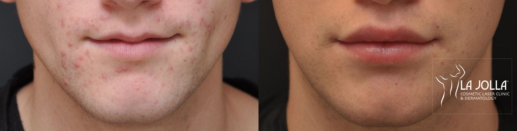 Before and after Lip Filler case 36310