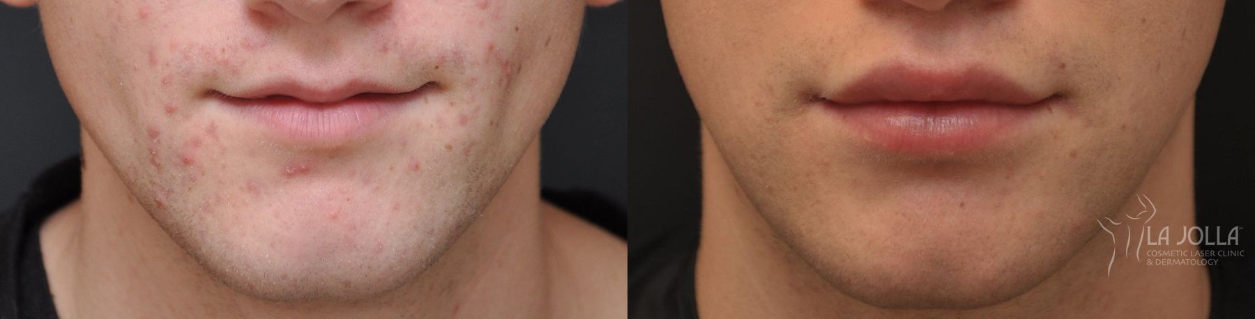 Before and after Lip Filler case 36310