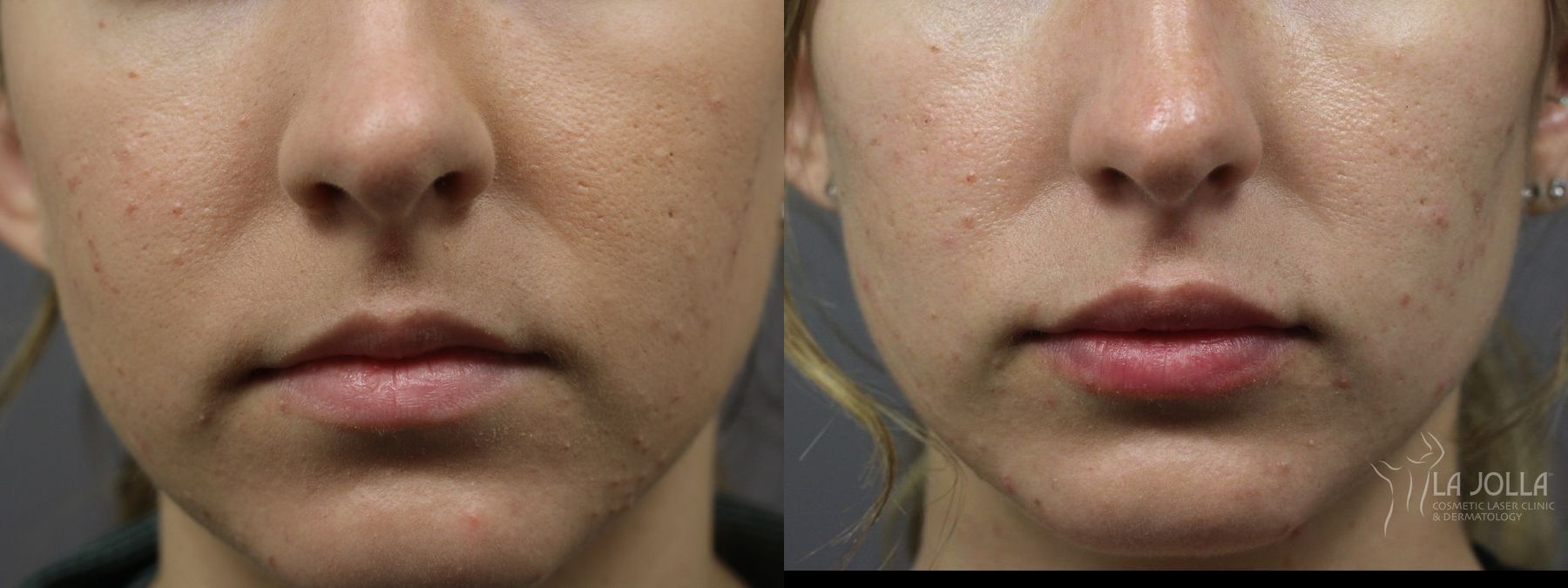 Before and after Lip Filler case 36317