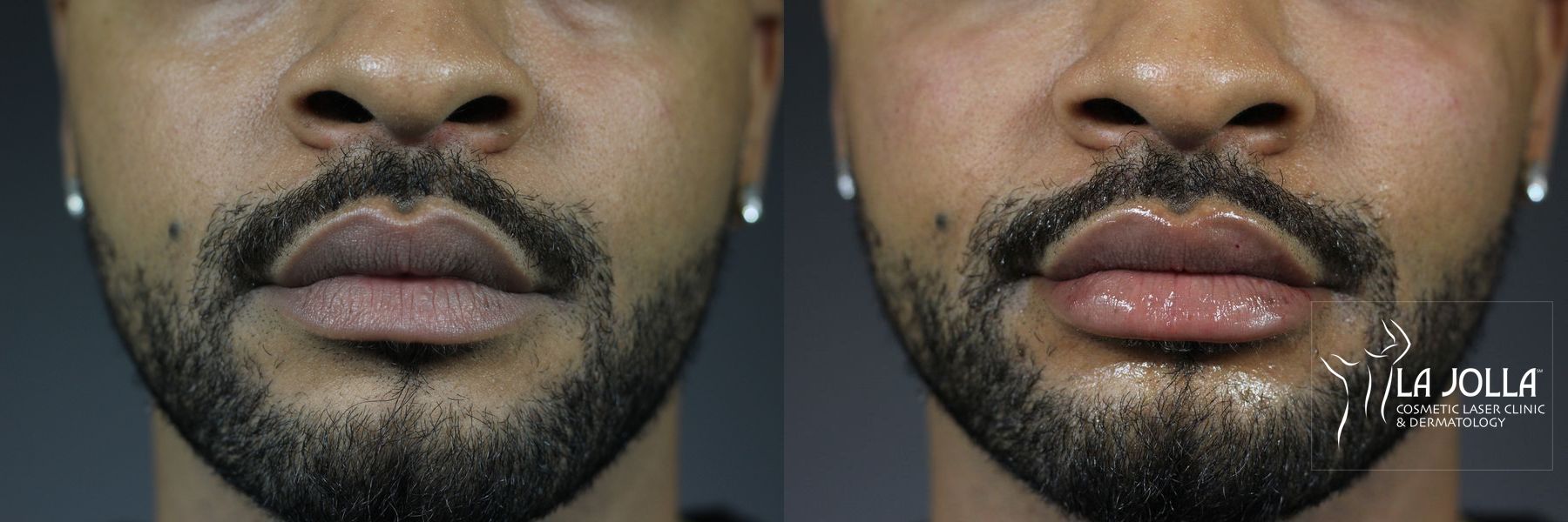 Before and after Lip Filler case 36336