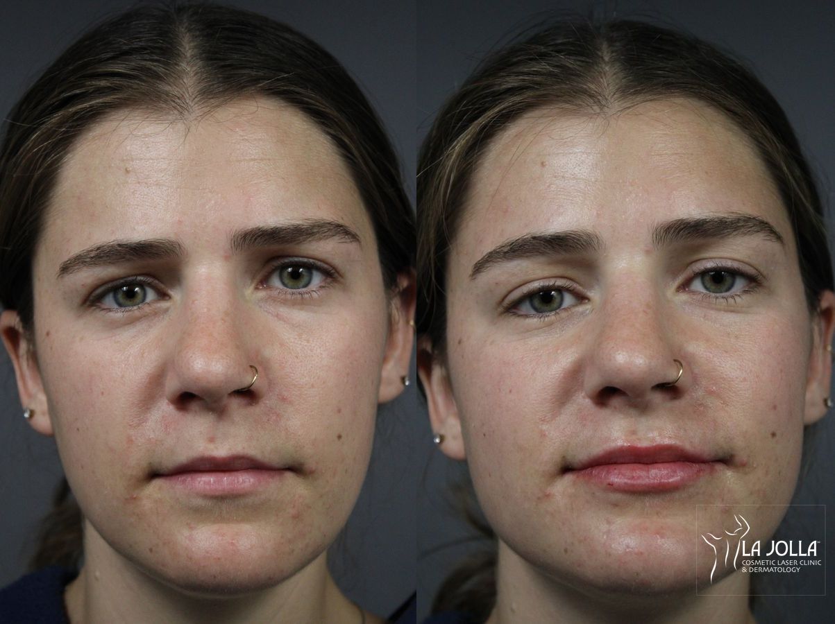 Before and after Lip Filler case 36141