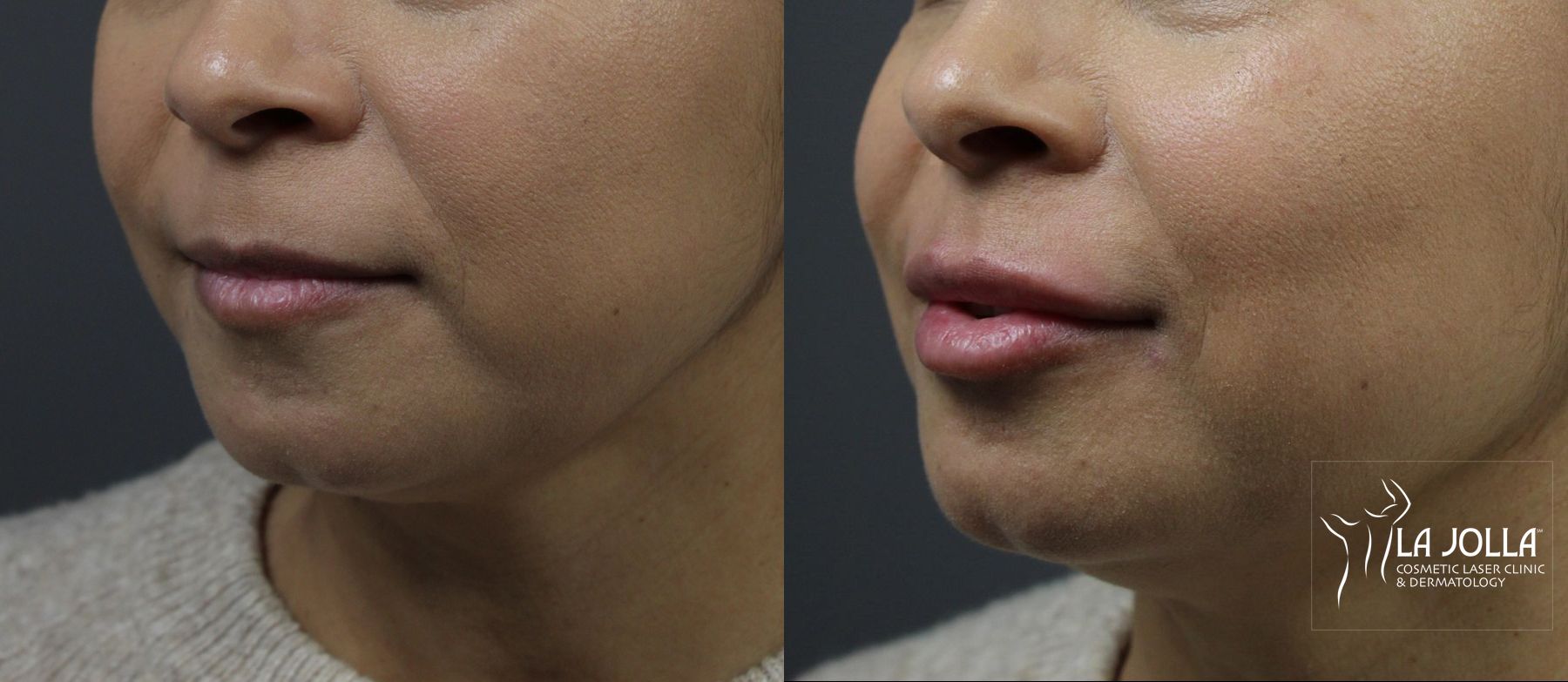 Before and after Lip Filler case 36080 - Angle 2