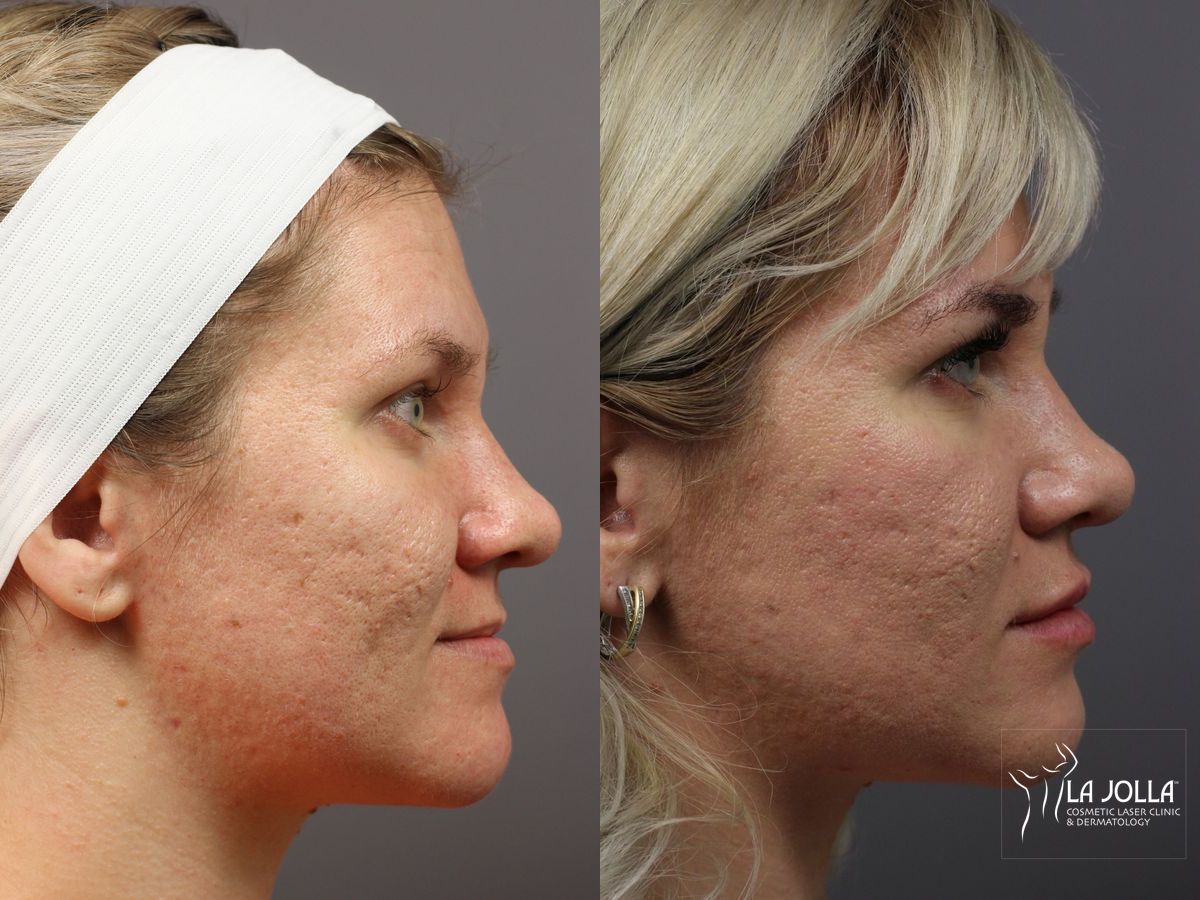 Before and after Lip Filler case 36212