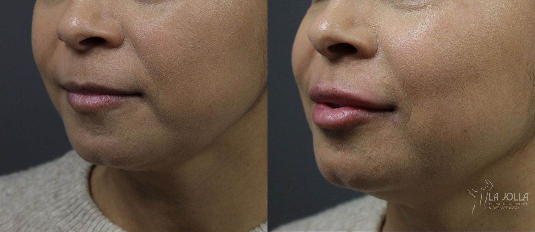 Before and after Lip Filler case 36080 - Angle 2