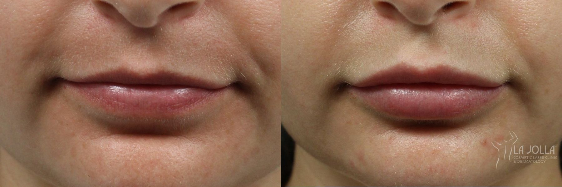 Before and after Lip Filler case 36231