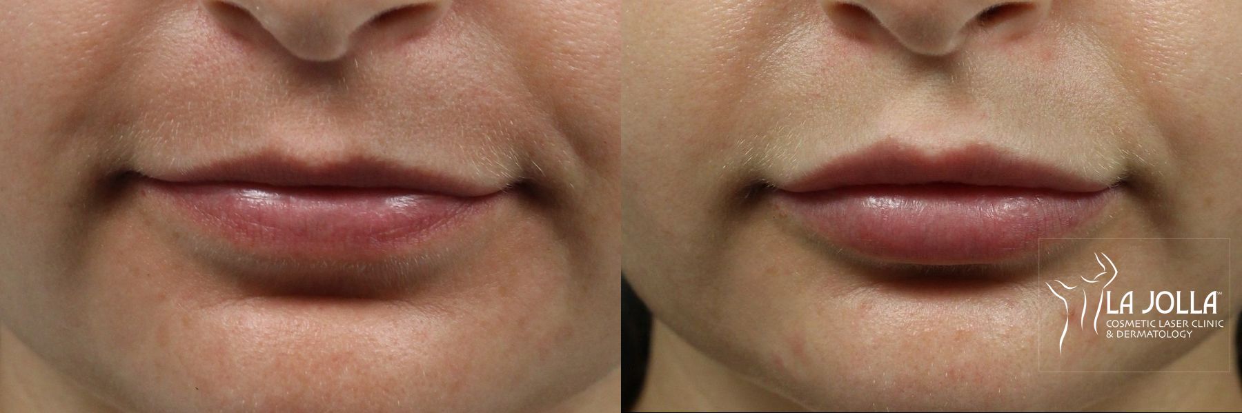 Before and after Lip Filler case 36231