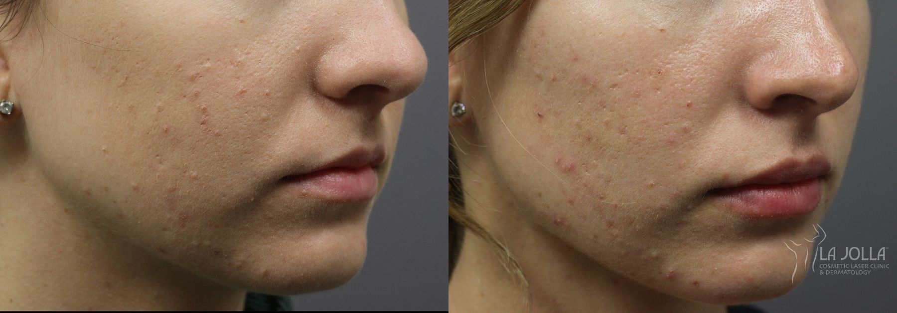 Before and after Lip Filler case 36317 - Angle 2