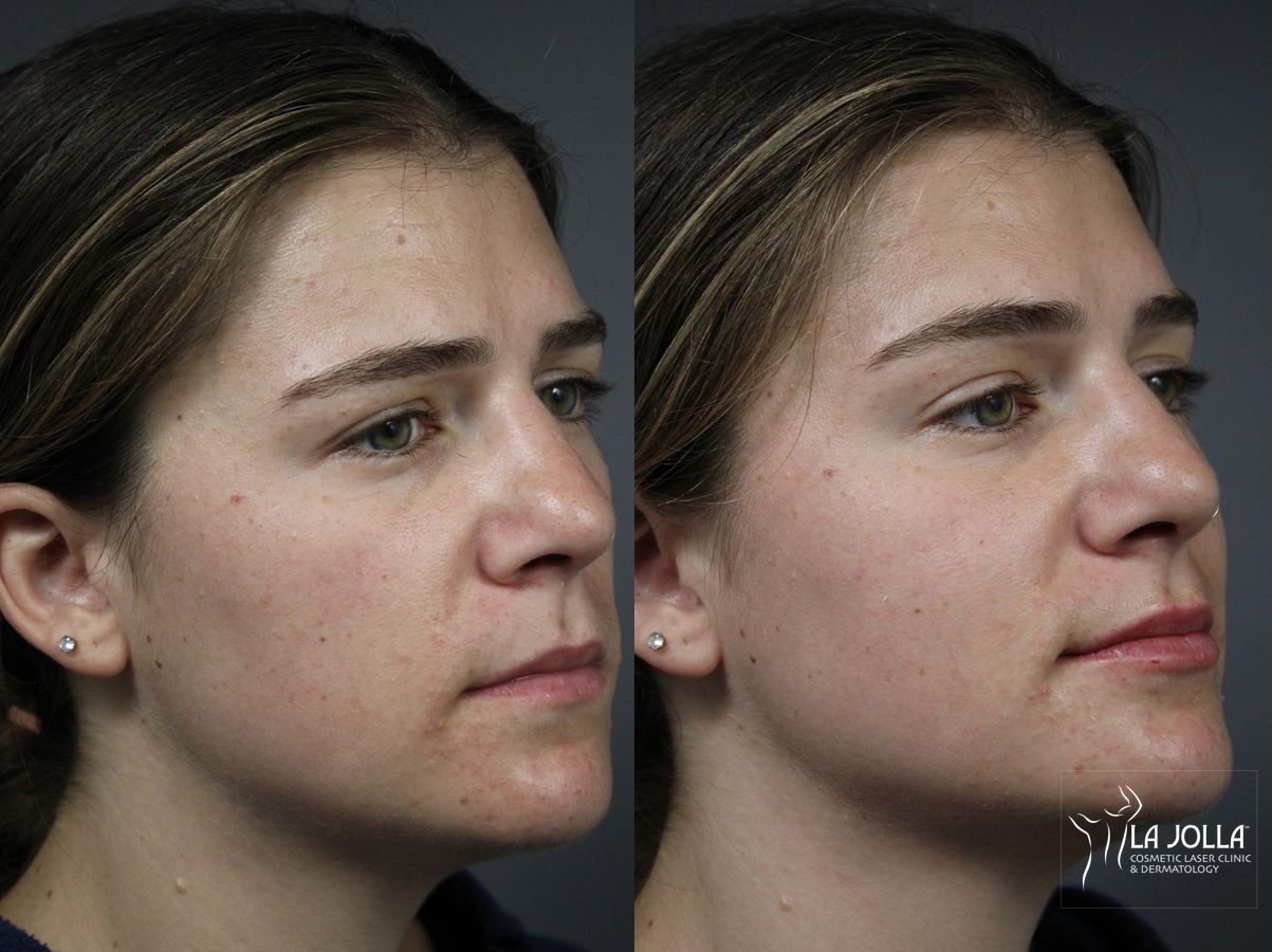 Before and after Lip Filler case 36141 - Angle 2