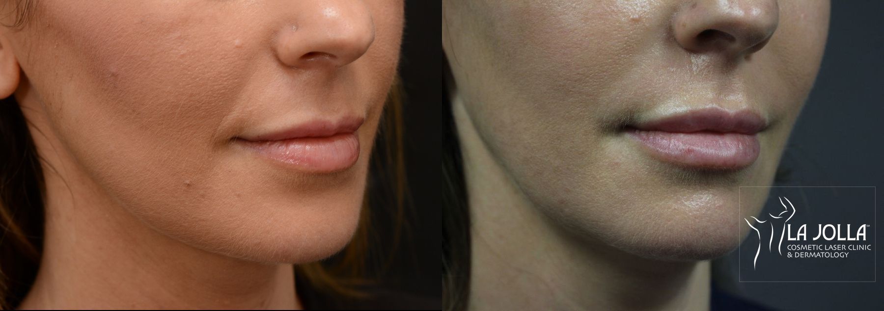 Before and after Lip Filler case 36290