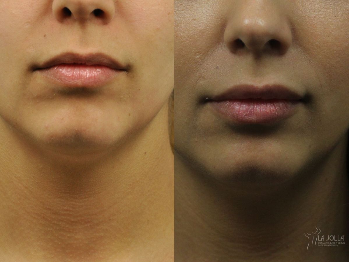 Before and after Lip Filler case 36273