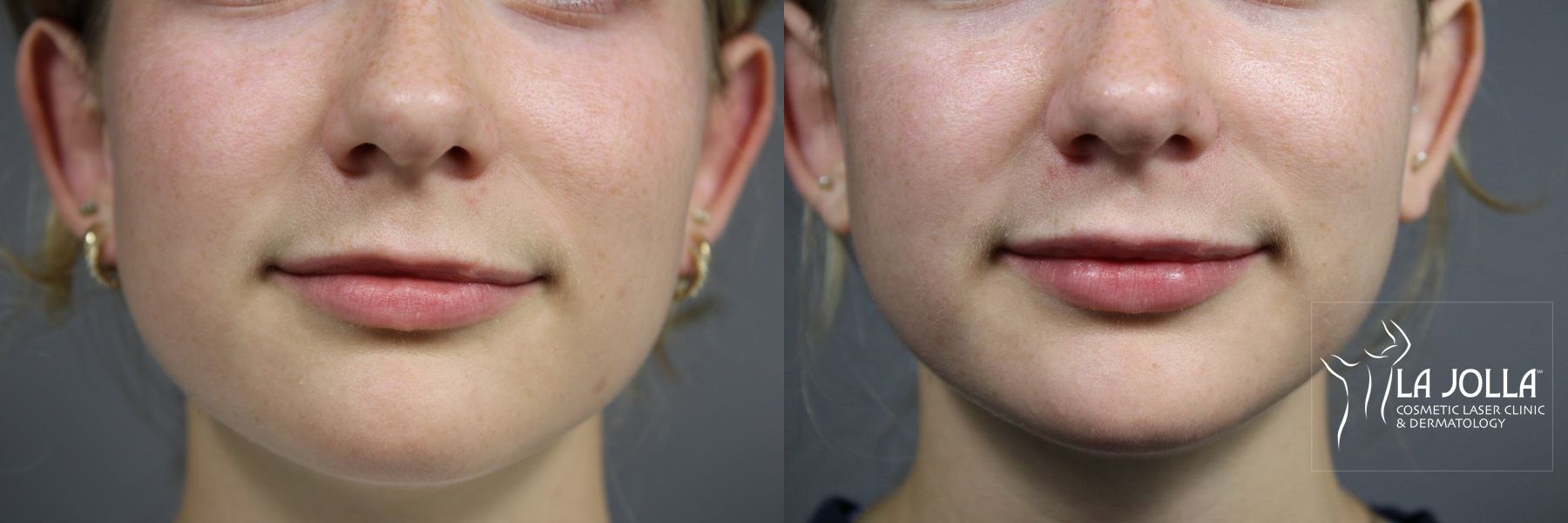 Before and after Lip Filler case 36098 - Angle 2