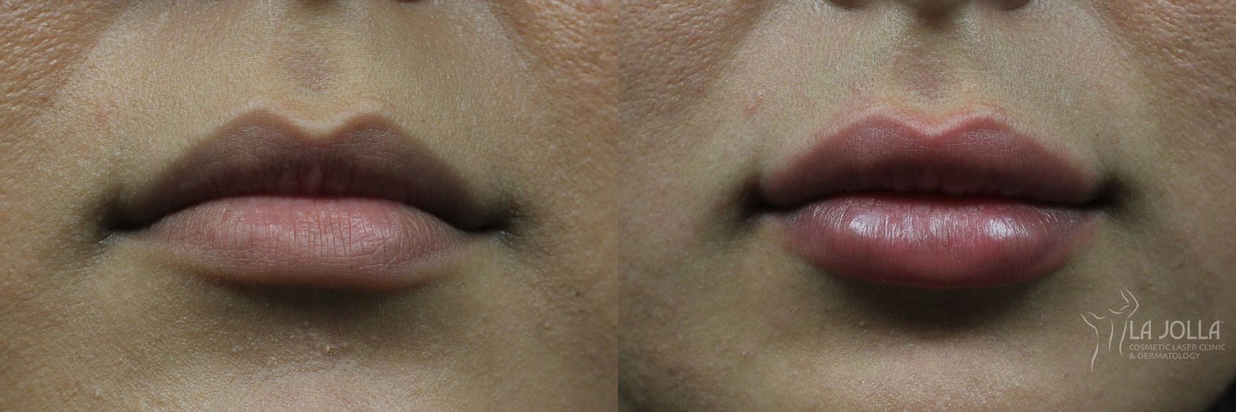 Before and after Lip Filler case 36139 - Angle 2