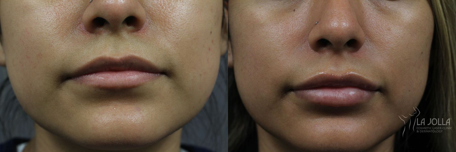 Before and after Lip Filler case 36321