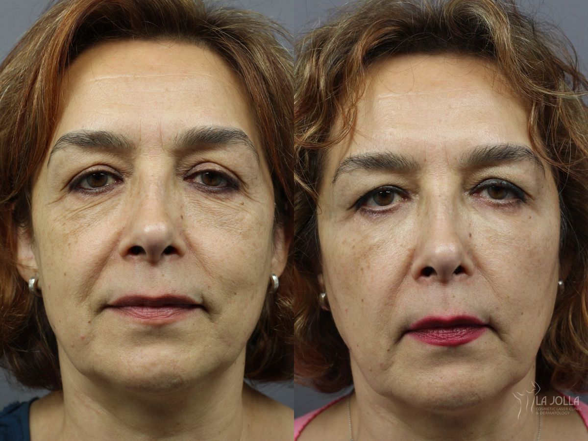 Before and after Lip Filler case 36314