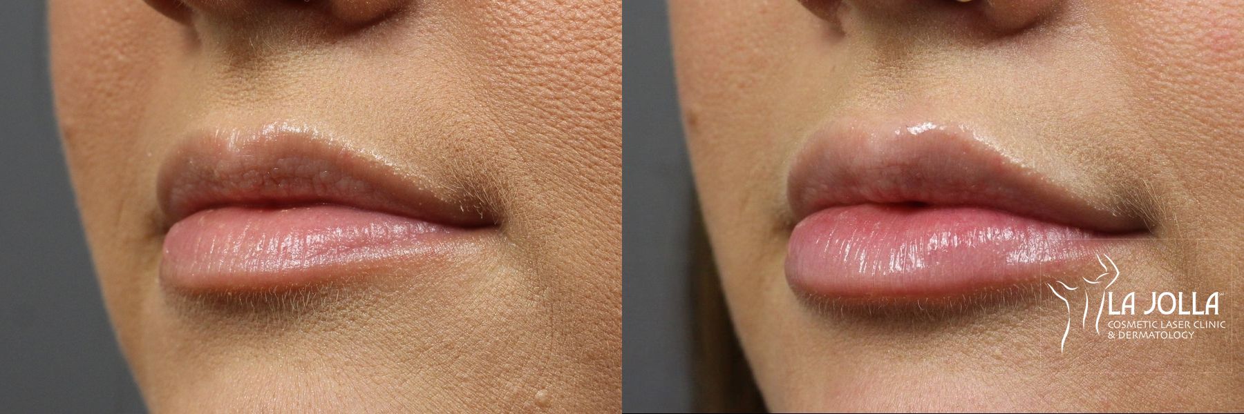 Before and after Lip Filler case 36266