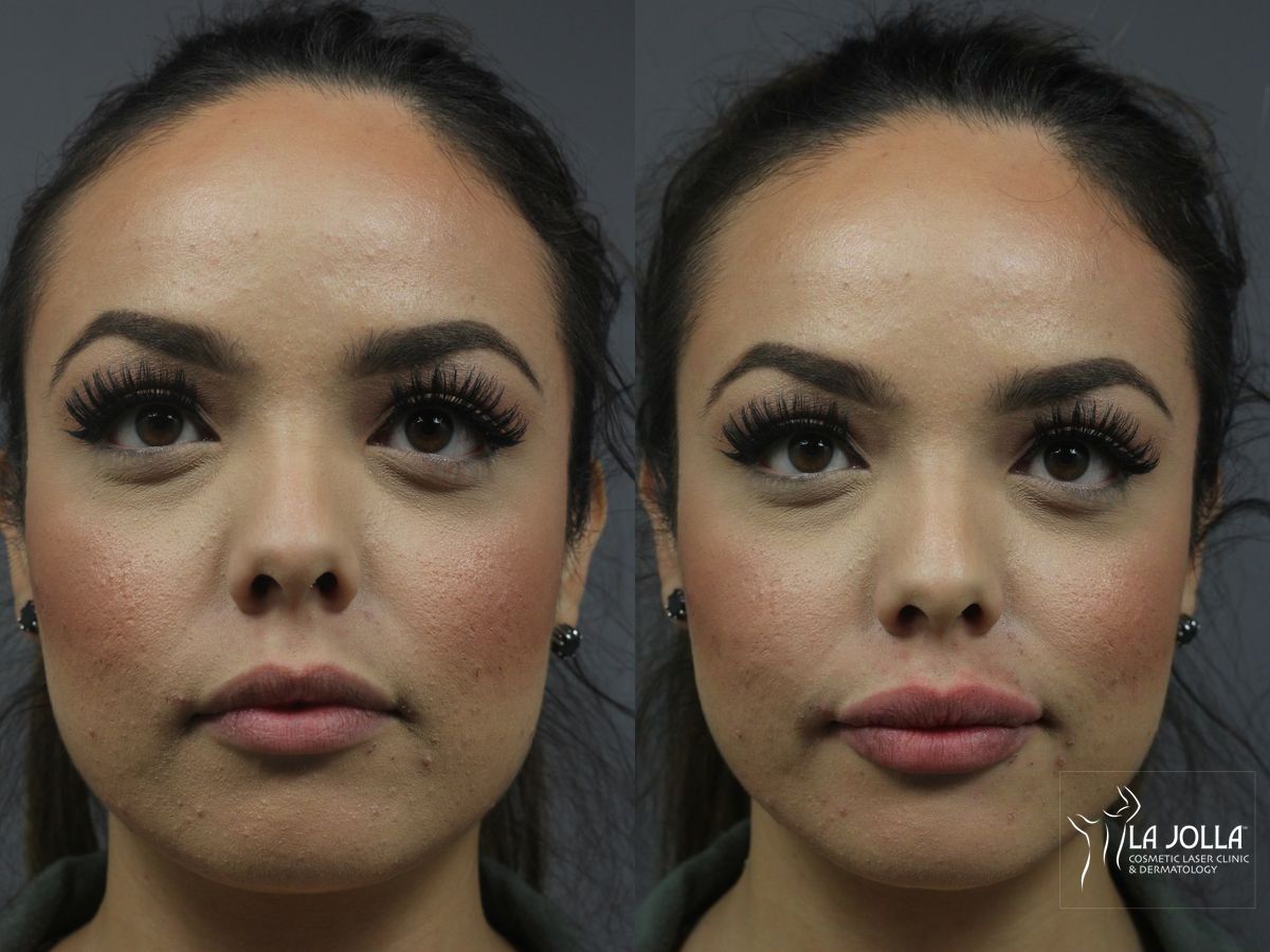 Before and after Lip Filler case 36205
