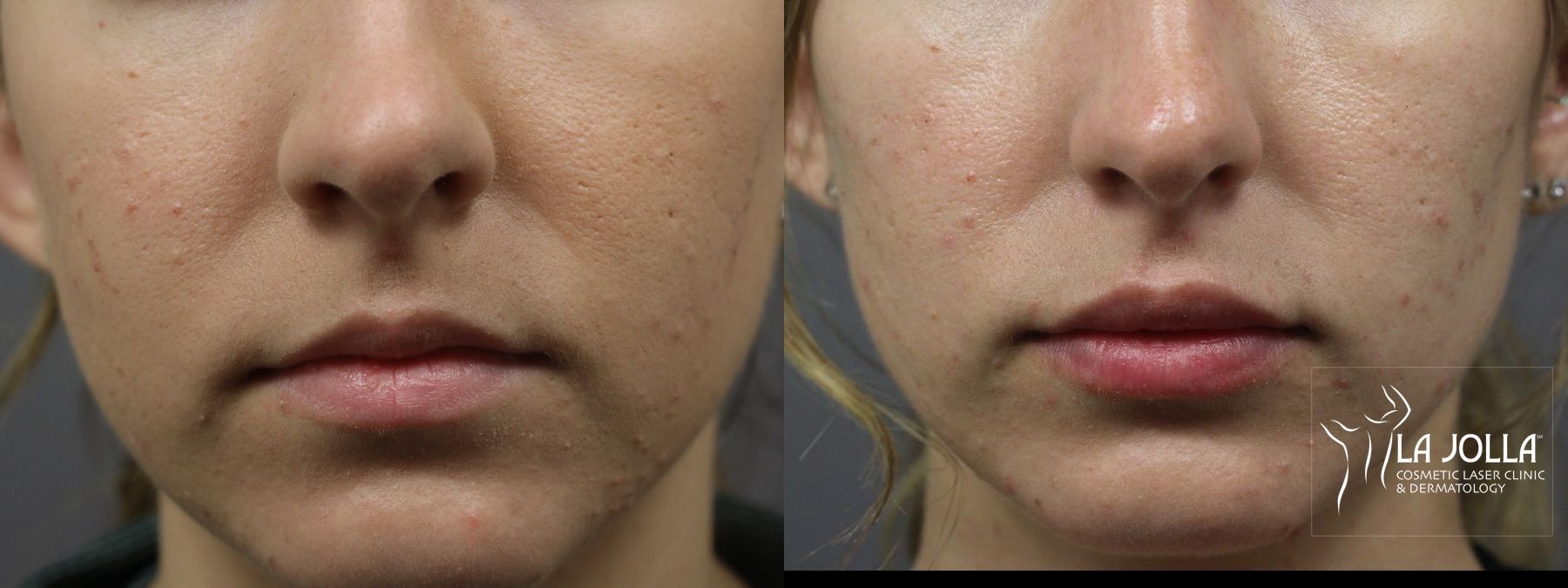 Before and after Lip Filler case 36317