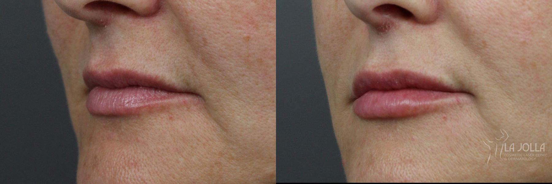 Before and after Lip Filler case 36186
