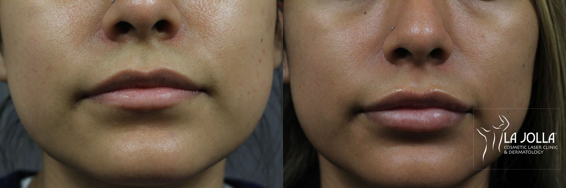 Before and after Lip Filler case 36321