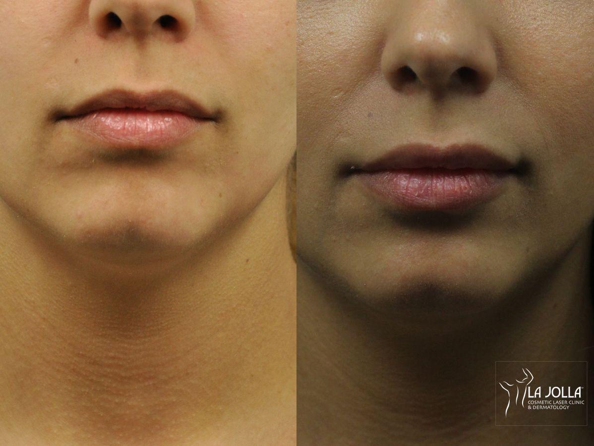 Before and after Lip Filler case 36273