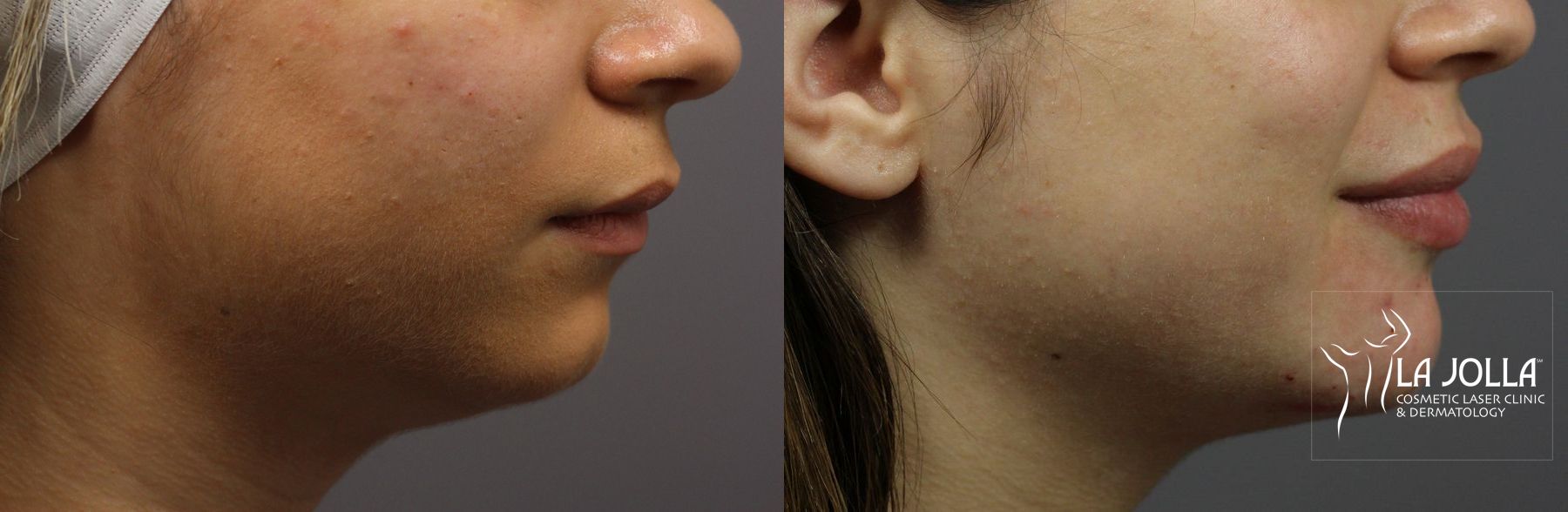 Before and after Lip Filler case 36326