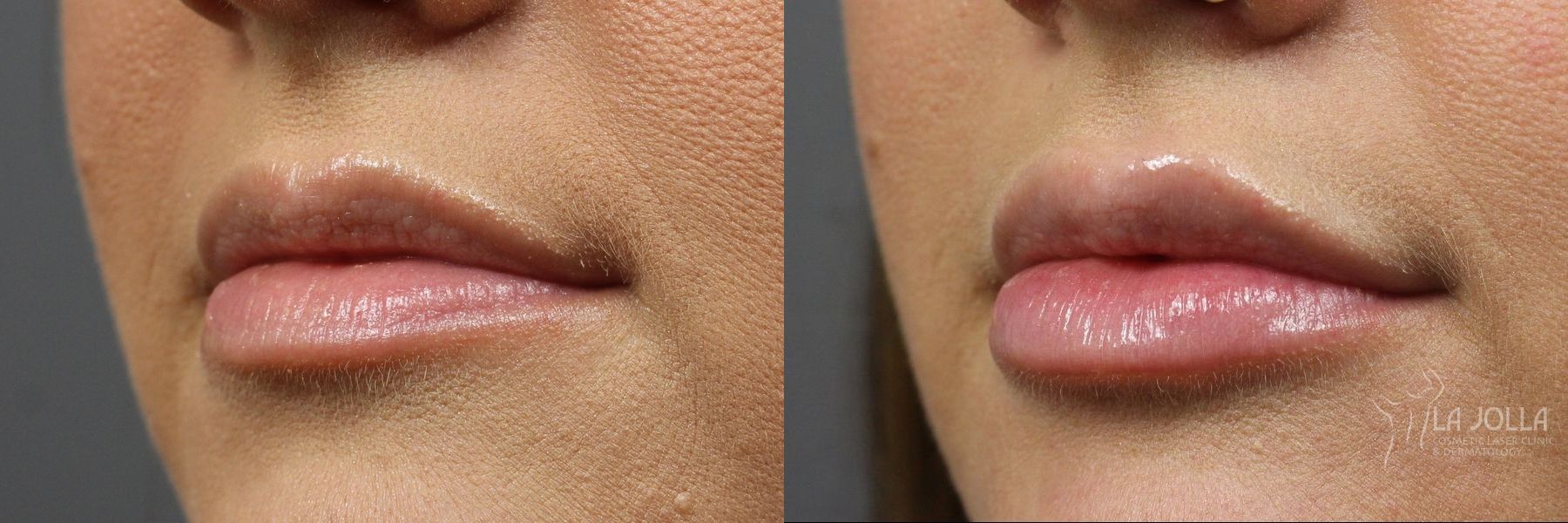 Before and after Lip Filler case 36174