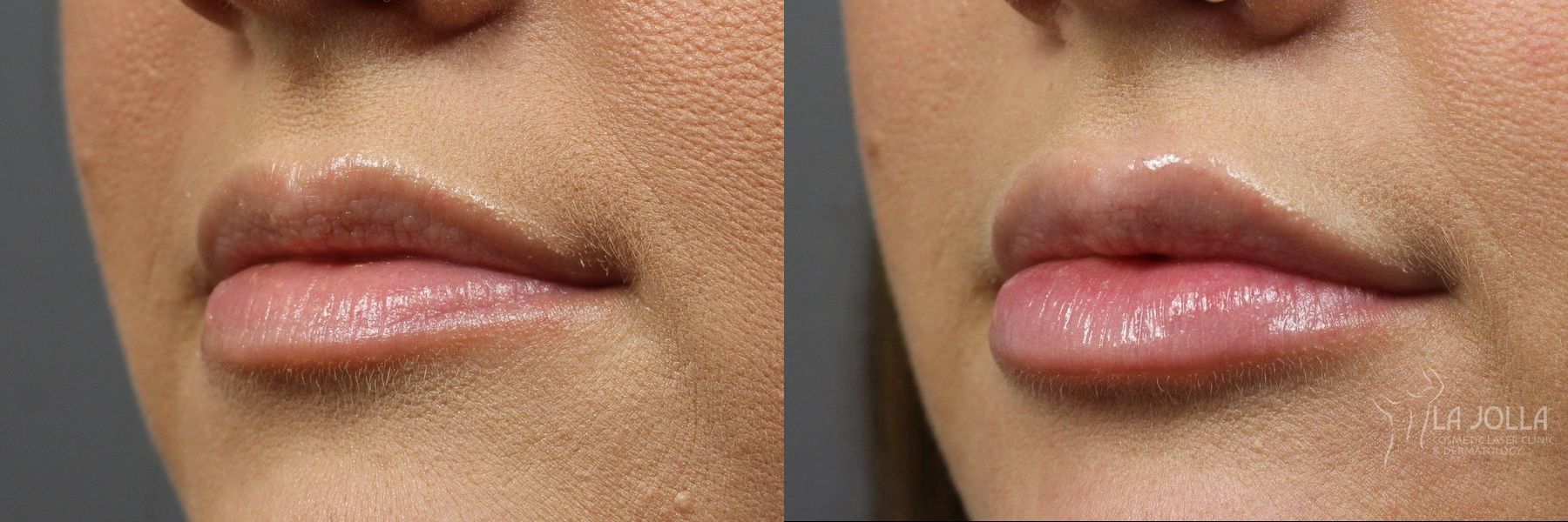 Before and after Lip Filler case 36266