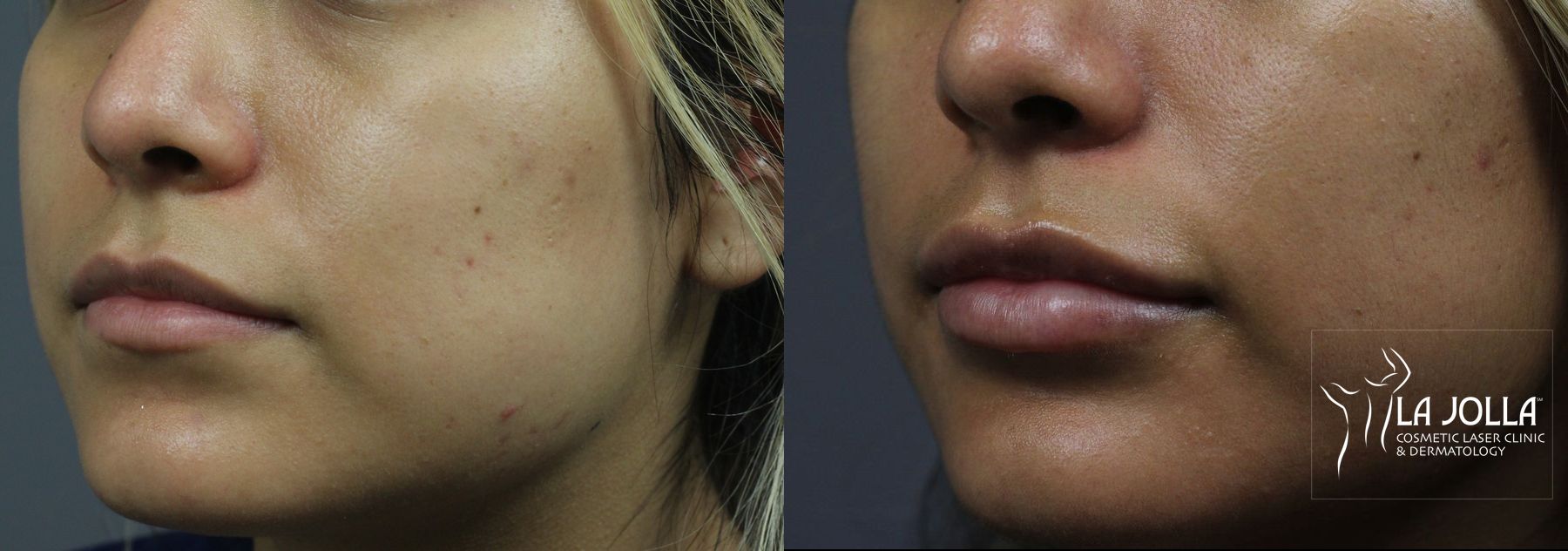 Before and after Lip Filler case 36321 - Angle 3