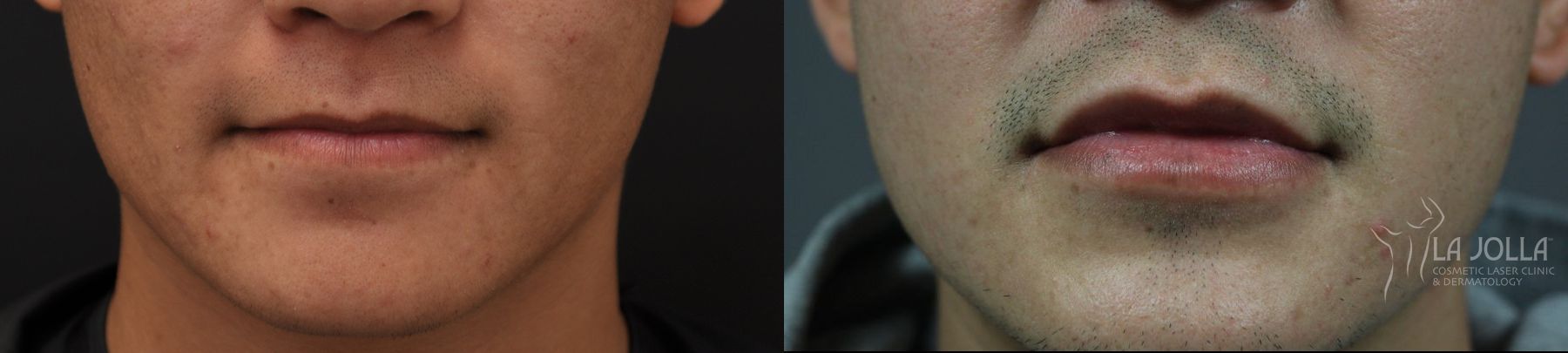 Before and after Lip Filler case 36293