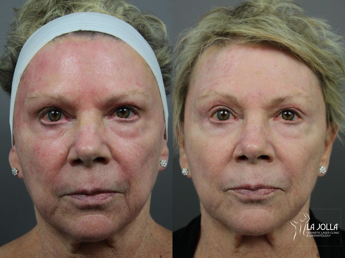 Before and after Liquid Facelift case 36422