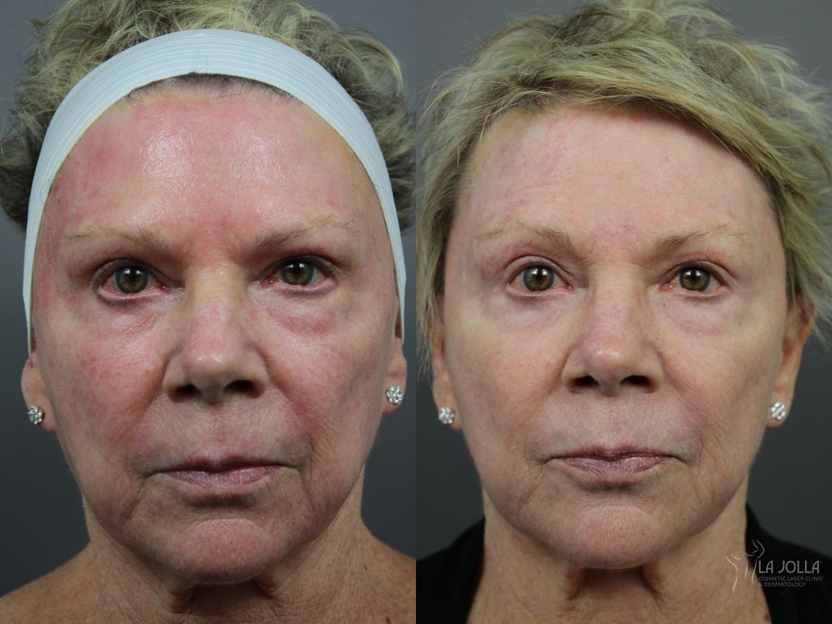 Before and after Liquid Facelift case 36422