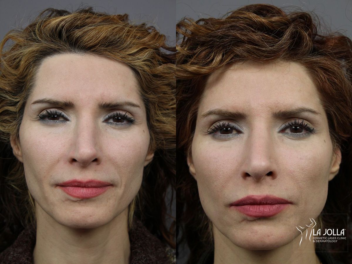 Before and after Liquid Facelift case 36417
