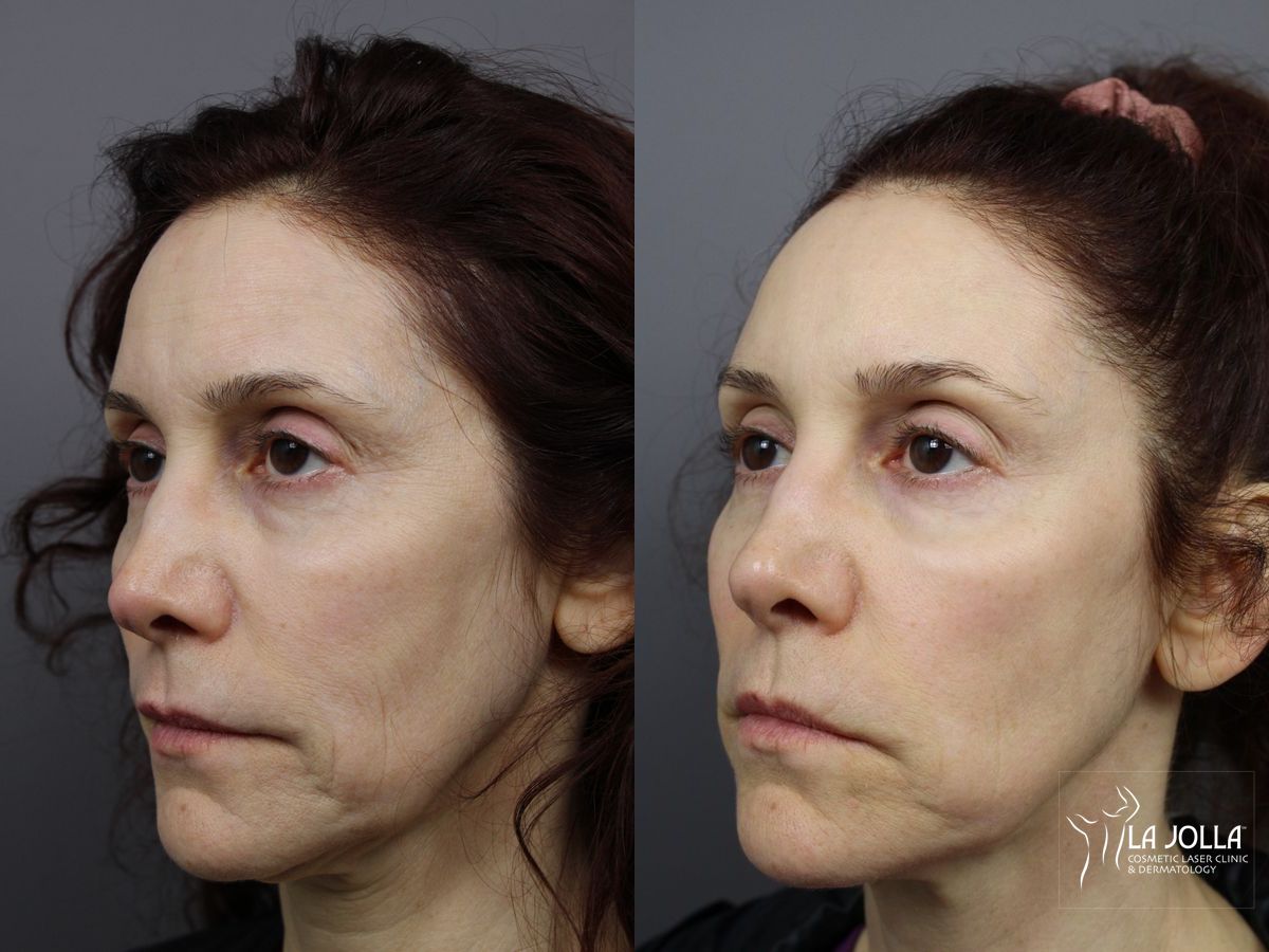 Before and after Liquid Facelift case 36412