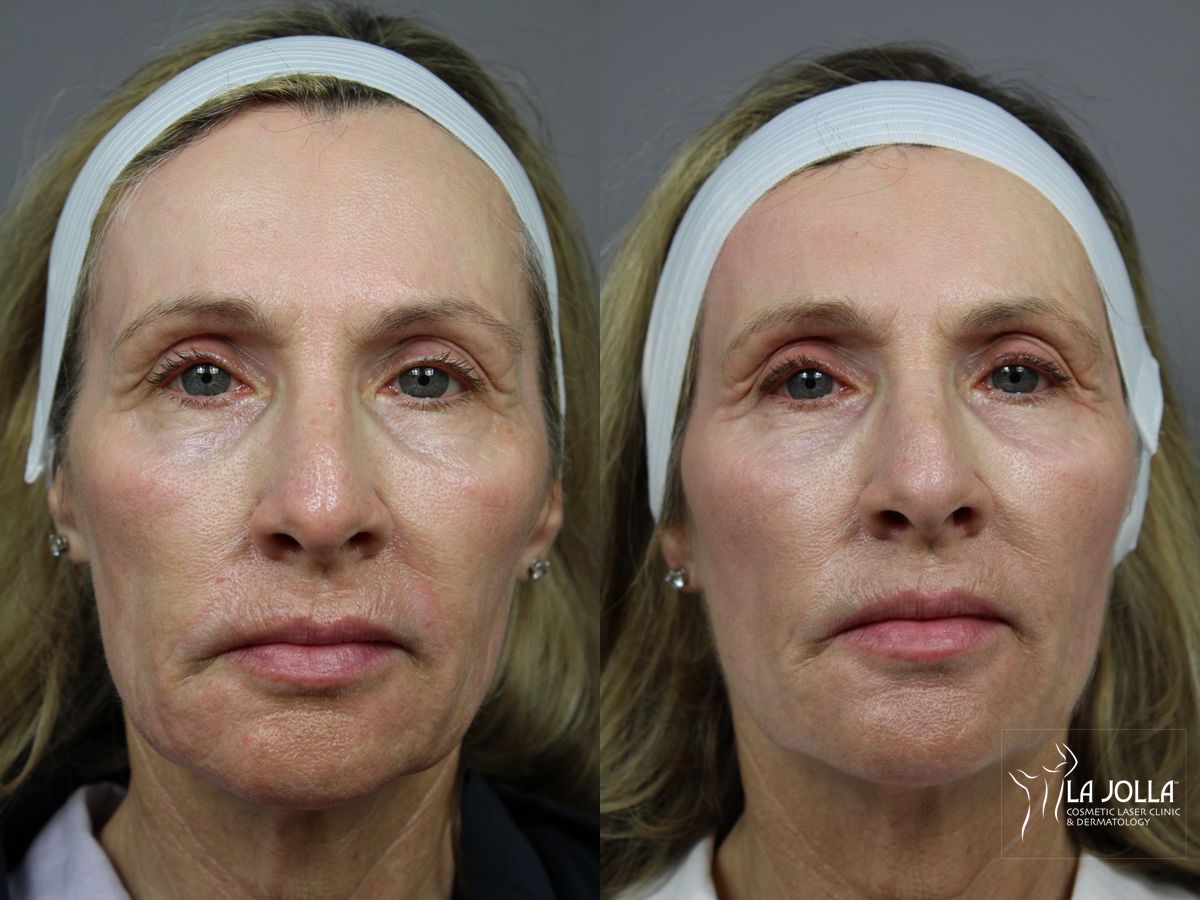 Before and after Liquid Facelift case 36414