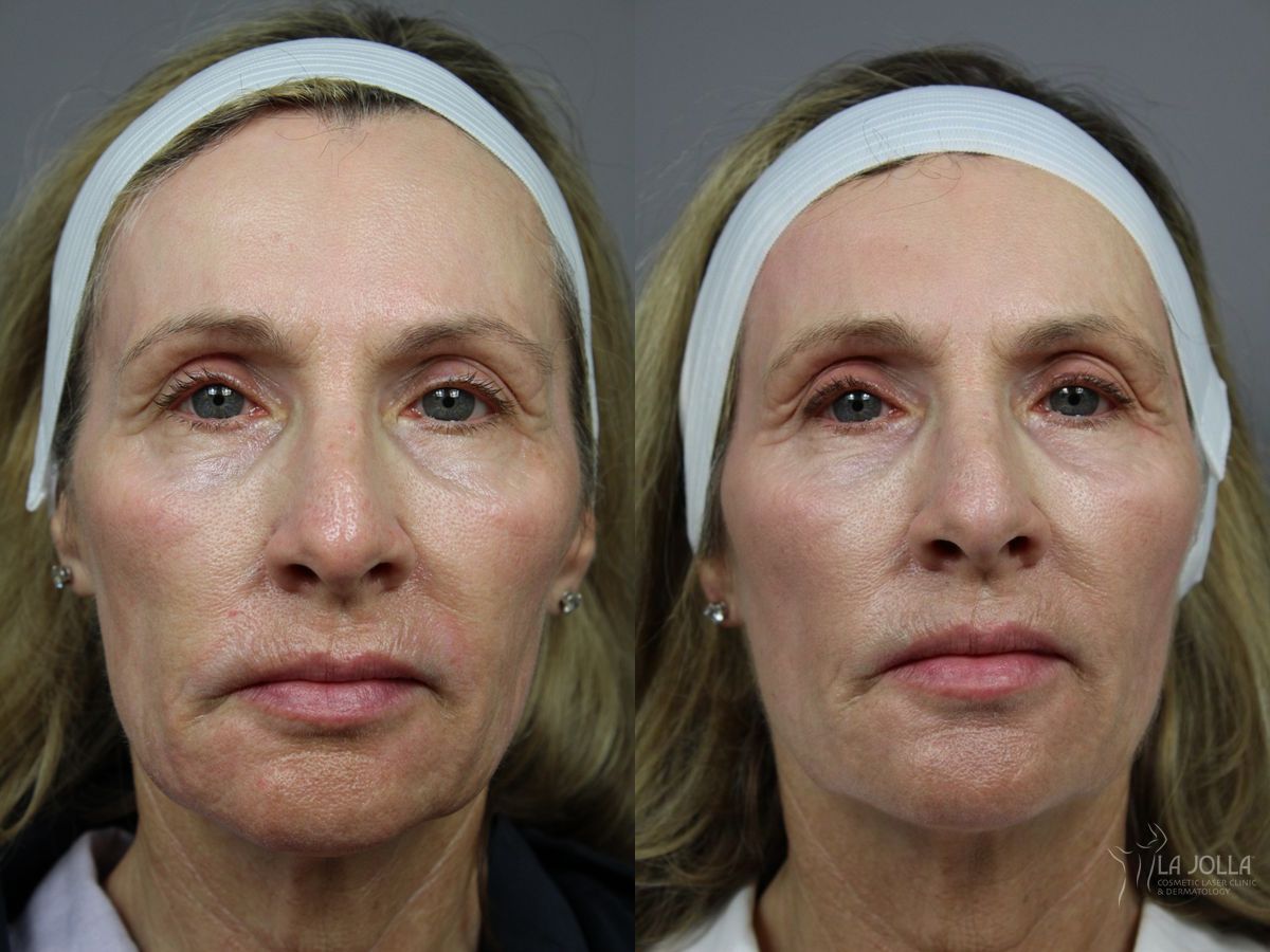 Before and after Liquid Facelift case 36414